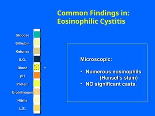 +
Common Findings in:
Eosinophilic Cystitis
Microscopic:
• Numerous eosinophils
(Hansel’s stain)
• NO significant casts.
Glucose
Bilirubin
Ketones
S.G.
Blood
pH
Protein
Nitrite
L.E.
Urobilinogen
 