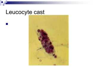 Leucocyte cast

 
