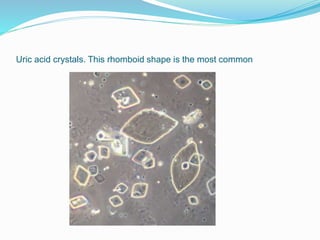 Uric acid crystals. This rhomboid shape is the most common
 