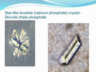 Star-like brushite (calcium phosphate) crystal-
Struvite (triple phosphate
 