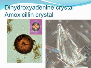 Dihydroxyadenine crystal
Amoxicillin crystal
 