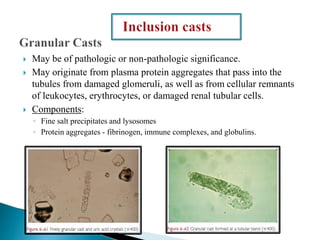  May be of pathologic or non-pathologic significance.
 May originate from plasma protein aggregates that pass into the
tubules from damaged glomeruli, as well as from cellular remnants
of leukocytes, erythrocytes, or damaged renal tubular cells.
 Components:
◦ Fine salt precipitates and lysosomes
◦ Protein aggregates - fibrinogen, immune complexes, and globulins.
 