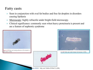  Seen in conjunction with oval fat bodies and free fat droplets in disorders
causing lipiduria
 Microscopy: highly refractile under bright-field microscopy.
 Clinical significance: commonly seen when heavy proteinuria is present and
are a feature of nephrotic syndrome
 
