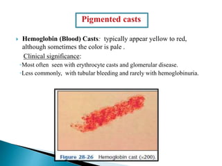  Hemoglobin (Blood) Casts: typically appear yellow to red,
although sometimes the color is pale .
Clinical significance:
◦Most often seen with erythrocyte casts and glomerular disease.
◦Less commonly, with tubular bleeding and rarely with hemoglobinuria.
 