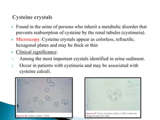  Found in the urine of persons who inherit a metabolic disorder that
prevents reabsorption of cysteine by the renal tubules (cystinuria).
 Microscopy: Cysteine crystals appear as colorless, refractile,
hexagonal plates and may be thick or thin
 Clinical significance:
1. Among the most important crystals identified in urine sediment.
2. Occur in patients with cystinuria and may be associated with
cysteine calculi.
 