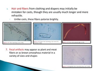 6. Hair and fibers from clothing and diapers may initially be
mistaken for casts, though they are usually much longer and more
refractile.
◦ Unlike casts, these fibers polarize brightly.
7. Fecal artifacts may appear as plant and meat
fibers or as brown amorphous material in a
variety of sizes and shapes
 