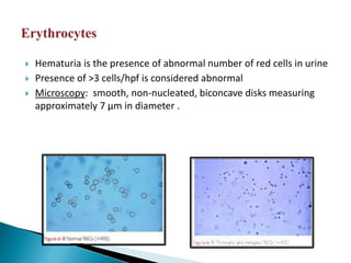  Hematuria is the presence of abnormal number of red cells in urine
 Presence of >3 cells/hpf is considered abnormal
 Microscopy: smooth, non-nucleated, biconcave disks measuring
approximately 7 μm in diameter .
 