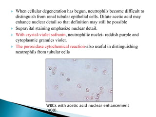  When cellular degeneration has begun, neutrophils become difficult to
distinguish from renal tubular epithelial cells. Dilute acetic acid may
enhance nuclear detail so that definition may still be possible
 Supravital staining emphasize nuclear detail.
 With crystal-violet safranin, neutrophilic nuclei- reddish purple and
cytoplasmic granules violet.
 The peroxidase cytochemical reaction-also useful in distinguishing
neutrophils from tubular cells
WBCs with acetic acid nuclear enhancement
(400).
 