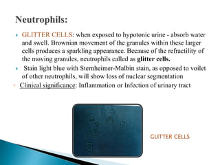  GLITTER CELLS: when exposed to hypotonic urine - absorb water
and swell. Brownian movement of the granules within these larger
cells produces a sparkling appearance. Because of the refractility of
the moving granules, neutrophils called as glitter cells.
 Stain light blue with Sternheimer-Malbin stain, as opposed to voilet
of other neutrophils, will show loss of nuclear segmentation
◦ Clinical significance: Inflammation or Infection of urinary tract
GLITTER CELLS
 