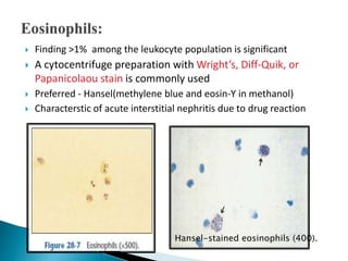  Finding >1% among the leukocyte population is significant
 A cytocentrifuge preparation with Wright’s, Diff-Quik, or
Papanicolaou stain is commonly used
 Preferred - Hansel(methylene blue and eosin-Y in methanol)
 Characterstic of acute interstitial nephritis due to drug reaction
Hansel-stained eosinophils (400).
 
