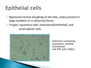  Represent normal sloughing of old cells, unless present in
large numbers or in abnormal forms.
 3 types: squamous cells, transitional(urothelial), and
renal tubular cells.
Sediment-containing
squamous, caudate
transitional,
and RTE cells (400x)
 