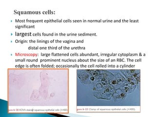  Most frequent epithelial cells seen in normal urine and the least
significant
 largest cells found in the urine sediment.
 Origin: the linings of the vagina and
distal one third of the urethra
 Microscopy: large flattened cells abundant, irregular cytoplasm & a
small round prominent nucleus about the size of an RBC. The cell
edge is often folded; occasionally the cell rolled into a cylinder
 