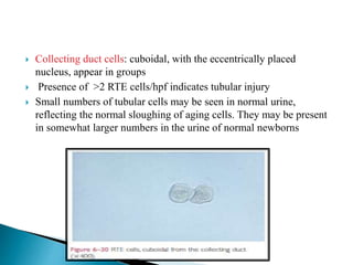  Collecting duct cells: cuboidal, with the eccentrically placed
nucleus, appear in groups
 Presence of >2 RTE cells/hpf indicates tubular injury
 Small numbers of tubular cells may be seen in normal urine,
reflecting the normal sloughing of aging cells. They may be present
in somewhat larger numbers in the urine of normal newborns
 