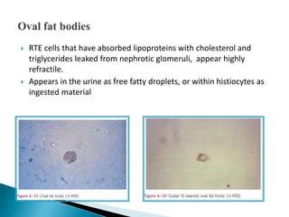  RTE cells that have absorbed lipoproteins with cholesterol and
triglycerides leaked from nephrotic glomeruli, appear highly
refractile.
 Appears in the urine as free fatty droplets, or within histiocytes as
ingested material
 