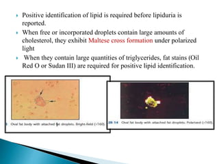  Positive identification of lipid is required before lipiduria is
reported.
 When free or incorporated droplets contain large amounts of
cholesterol, they exhibit Maltese cross formation under polarized
light
 When they contain large quantities of triglycerides, fat stains (Oil
Red O or Sudan III) are required for positive lipid identification.
 