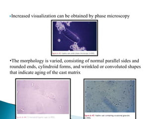 Increased visualization can be obtained by phase microscopy
•The morphology is varied, consisting of normal parallel sides and
rounded ends, cylindroid forms, and wrinkled or convoluted shapes
that indicate aging of the cast matrix
 
