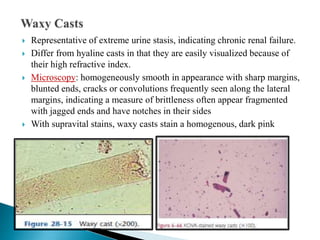  Representative of extreme urine stasis, indicating chronic renal failure.
 Differ from hyaline casts in that they are easily visualized because of
their high refractive index.
 Microscopy: homogeneously smooth in appearance with sharp margins,
blunted ends, cracks or convolutions frequently seen along the lateral
margins, indicating a measure of brittleness often appear fragmented
with jagged ends and have notches in their sides
 With supravital stains, waxy casts stain a homogenous, dark pink
 