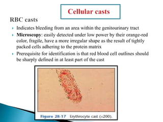  Indicates bleeding from an area within the genitourinary tract
 Microscopy: easily detected under low power by their orange-red
color, fragile, have a more irregular shape as the result of tightly
packed cells adhering to the protein matrix
 Prerequisite for identification is that red blood cell outlines should
be sharply defined in at least part of the cast
 