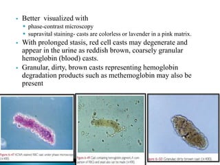  Better visualized with
 phase-contrast microscopy
 supravital staining- casts are colorless or lavender in a pink matrix.
 With prolonged stasis, red cell casts may degenerate and
appear in the urine as reddish brown, coarsely granular
hemoglobin (blood) casts.
 Granular, dirty, brown casts representing hemoglobin
degradation products such as methemoglobin may also be
present
 