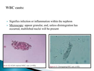  Signifies infection or inflammation within the nephron
 Microscopy: appear granular, and, unless disintegration has
occurred, multilobed nuclei will be present
 