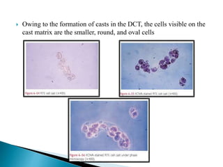  Owing to the formation of casts in the DCT, the cells visible on the
cast matrix are the smaller, round, and oval cells
 