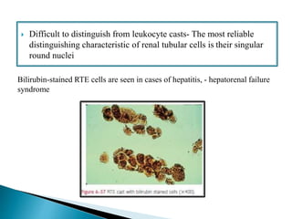  Difficult to distinguish from leukocyte casts- The most reliable
distinguishing characteristic of renal tubular cells is their singular
round nuclei
Bilirubin-stained RTE cells are seen in cases of hepatitis, - hepatorenal failure
syndrome
 