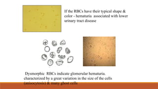 If the RBCs have their typical shape &
color - hematuria associated with lower
urinary tract disease.
Dysmorphic RBCs indicate glomerular hematuria.
characterized by a great variation in the size of the cells
(anisocytosis) & many ghost cells
 