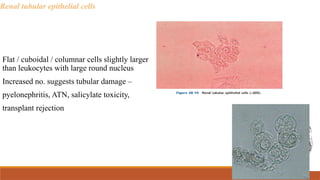 Renal tubular epithelial cells
Flat / cuboidal / columnar cells slightly larger
than leukocytes with large round nucleus
Increased no. suggests tubular damage –
pyelonephritis, ATN, salicylate toxicity,
transplant rejection
 
