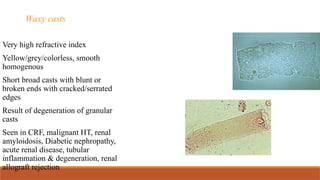 Waxy casts
Very high refractive index
Yellow/grey/colorless, smooth
homogenous
Short broad casts with blunt or
broken ends with cracked/serrated
edges
Result of degeneration of granular
casts
Seen in CRF, malignant HT, renal
amyloidosis, Diabetic nephropathy,
acute renal disease, tubular
inflammation & degeneration, renal
allograft rejection
 