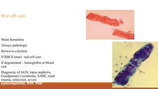 Red cell casts
Mean hematuria
Always pathologic
Brown to colorless
If RBCS intact –red cell cast
If degenerated – hemoglobin or blood
cast
Diagnostic of AGN, lupus nephritis,
Goodpasture’s syndrome, SABE, renal
trauma, infarction, severe
pyelonephritis, RVF, PAN
 