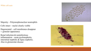 White cell casts
Majority – Polymorphonuclear neutrophils
Cells intact – nuclei clearly visible
Degenerated – cell membranes disappear
-- granular appearance
Renal infection & noninfectious
inflammation – acute pyelonephritis,
interstitial nephritis & lupus nephritis.
Also in glomerular disease
 