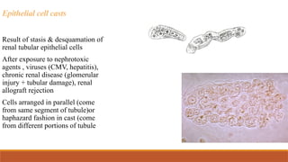 Epithelial cell casts
Result of stasis & desquamation of
renal tubular epithelial cells
After exposure to nephrotoxic
agents , viruses (CMV, hepatitis),
chronic renal disease (glomerular
injury + tubular damage), renal
allograft rejection
Cells arranged in parallel (come
from same segment of tubule)or
haphazard fashion in cast (come
from different portions of tubule)
 