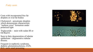 Fatty casts
Casts with incorporated free fat
droplets or oval fat bodies
Cholesterol - anisotropic droplets
which demonstrate characteristic
“maltese cross” formation under
polarized light
Triglyceride - stain with sudan III or
Oil Red O.
Seen in fatty degeneration of tubular
epithelium – degenerative tubular
disease.
Frequent in nephrotic syndrome,
diabetic glomerulosclerosis, CGN,
SLE, toxic renal poisoning
 