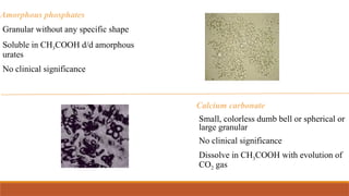 Amorphous phosphates
Granular without any specific shape
Soluble in CH3COOH d/d amorphous
urates
No clinical significance
Calcium carbonate
Small, colorless dumb bell or spherical or
large granular
No clinical significance
Dissolve in CH3COOH with evolution of
CO2 gas
 