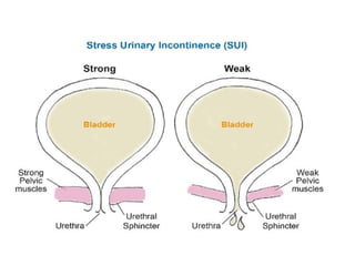 Comprehensive Nursing Guide on Urinary Elimination and Incontinence ...
