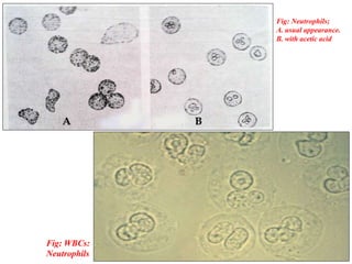 Fig: Neutrophils;
A. usual appearance.
B. with acetic acid
Fig: WBCs:
Neutrophils
 