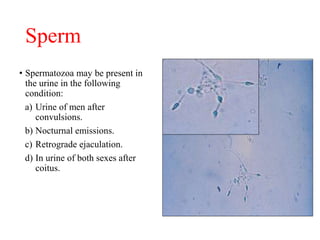 Sperm
• Spermatozoa may be present in
the urine in the following
condition:
a) Urine of men after
convulsions.
b) Nocturna...