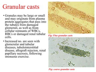Granular casts
• Granules may be large or small
and may originate from plasma
protein aggregates that pass into
the tubule...