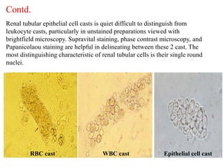 Contd.
Renal tubular epithelial cell casts is quiet difficult to distinguish from
leukocyte casts, particularly in unstain...