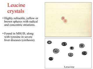 Leucine
crystals
• Highly refractile, yellow or
brown spheres with radical
and concentric striations.
• Found in MSUD, alo...