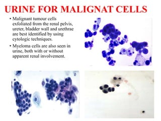 URINE FOR MALIGNAT CELLS
• Malignant tumour cells
exfoliated from the renal pelvis,
ureter, bladder wall and urethrae
are ...