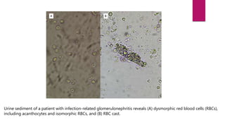 Urine sediment examination in the diagnosis and management | PPTX