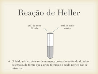 Reação de Heller
❖ O ácido nítrico deve ser lentamente colocado no fundo do tubo
de ensaio, de forma que a urina ﬁltrada e o ácido nítrico não se
misturem.
2mL de ácido
nítrico
3mL de urina
ﬁltrada
 