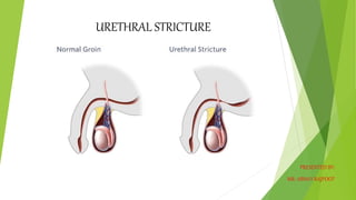 URETHRAL STRICTURE
PRESENTED BY:
MR: ABHAY RAJPOOT
 