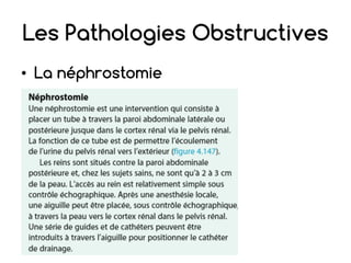 Les Pathologies Obstructives
• La néphrostomie
 
