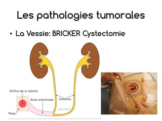 • La Vessie: BRICKER Cystectomie
Les pathologies tumorales
 
