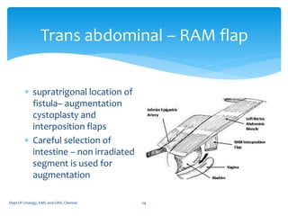 Interposition Flap Uro gynacology- radiation f. | PDF