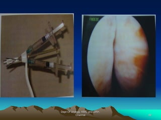 Dept Of Urology, KMC and GRH,
Chennai 48
 