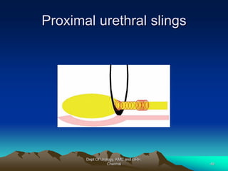 Proximal urethral slings
Dept Of Urology, KMC and GRH,
Chennai 49
 