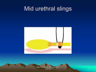 Mid urethral slings
Dept Of Urology, KMC and GRH,
Chennai 50
 